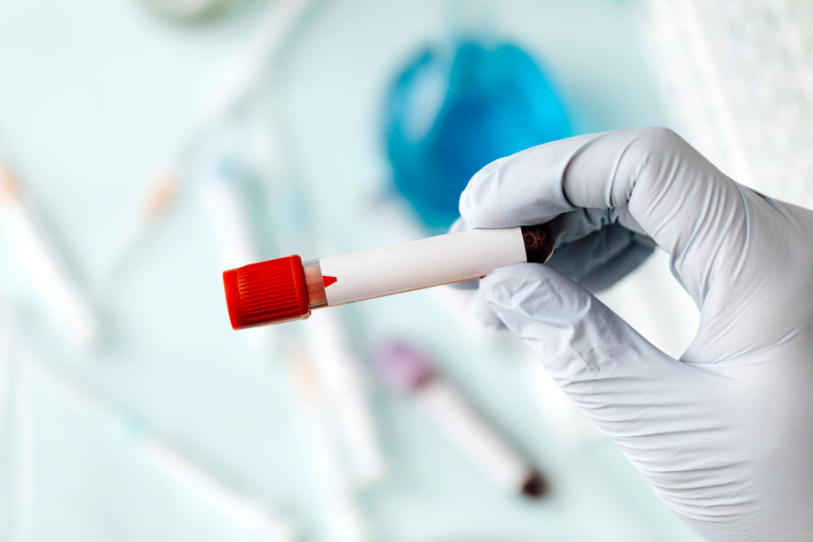 Hyperlipidémia (dyslipidémia)